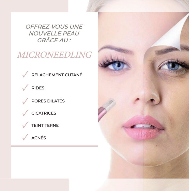 microneedling